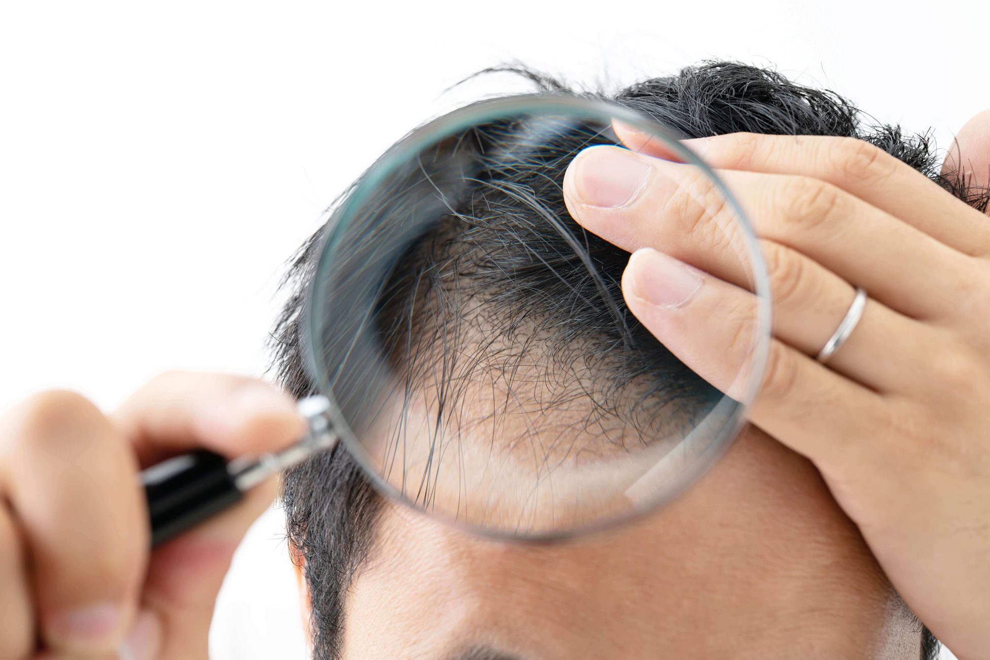 Hair Restoration Procedures