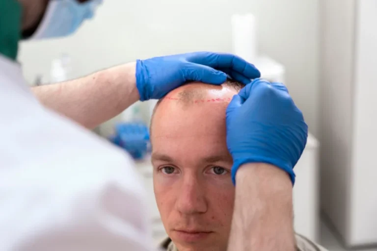 How To Understand Fue And Fut A Comparison Of Two Hair Transplant Methods
